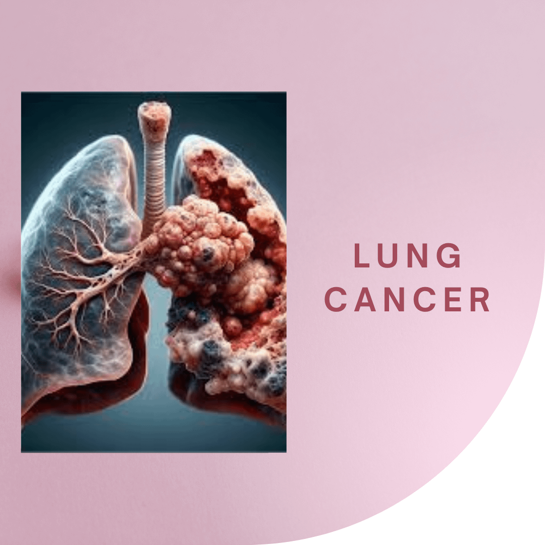 Recent Advances in Lung Cancer Research: A Comprehensive Overview